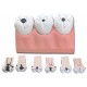 Caries dentaires - 7 pièces - 4X