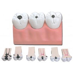 Caries dentaires - 7 pièces - 4X