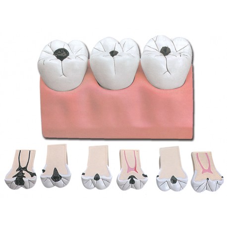 Caries dentaires - 7 pièces - 4X