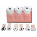 Caries dentaires - 7 pièces - 4X