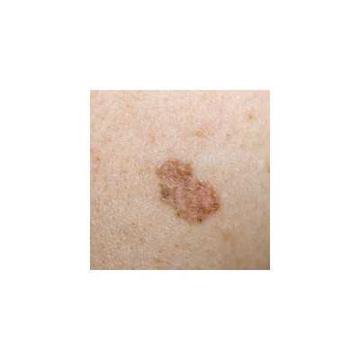 Dermatoscope LuxaScope CCT LED 2,5 V Noir Luxamed | Consomed